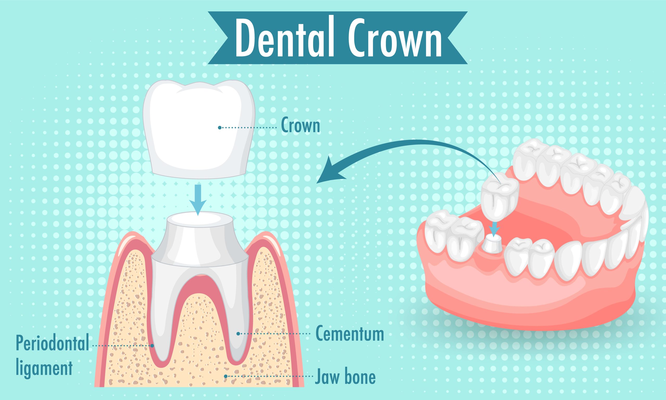 dental Crown at Layton Family Dental Care